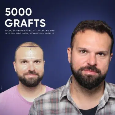 DHI Hair Transplant in Turkey