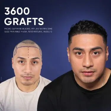 DHI Hair Transplant in Turkey