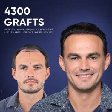 DHI Hair Transplant in Turkey