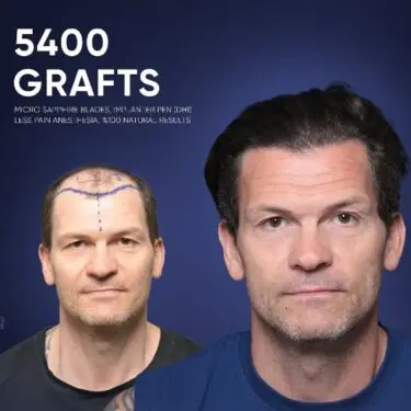 DHI Hair Transplant in Turkey