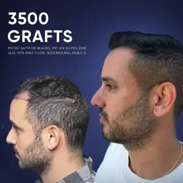 DHI Hair Transplant in Turkey