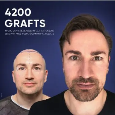 DHI Hair Transplant in Turkey