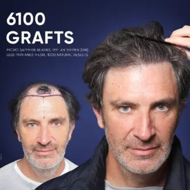 DHI Hair Transplant in Turkey