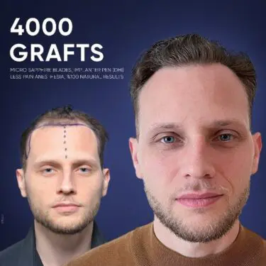 DHI Hair Transplant in Turkey