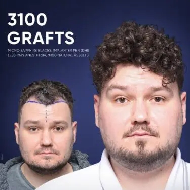 DHI Hair Transplant in Turkey