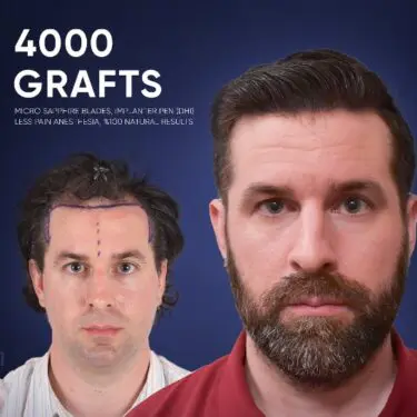 DHI Hair Transplant in Turkey