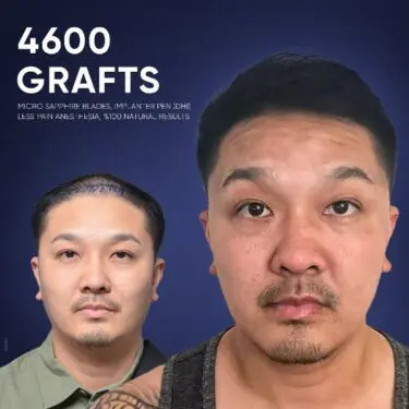 DHI Hair Transplant in Turkey