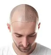 Hair transplantation