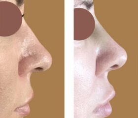 Nose reshaping with fillers