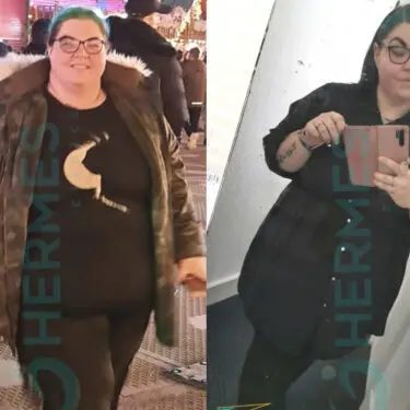 - 23 кг після рукавної резекції шлунка