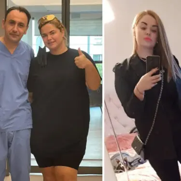 3 місяця після рукавної резекції шлунка