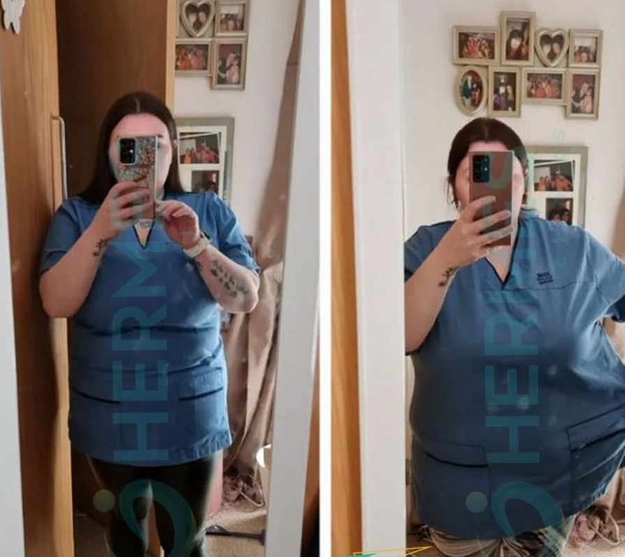 1,5 month after gastric sleeve