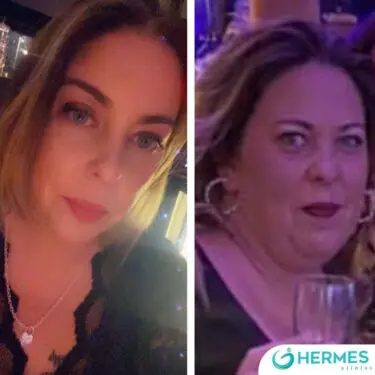 Рукавна резекція шлунка