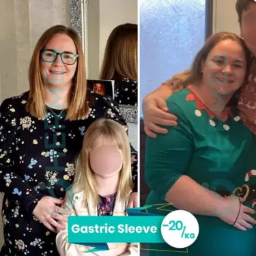 - 20 кг після рукавної резекції шлунка