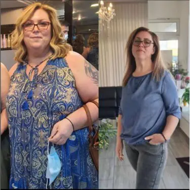 Зменшення шлунка для зниження ваги