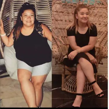 Зменшення шлунка для зниження ваги