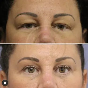 Blepharoplastik