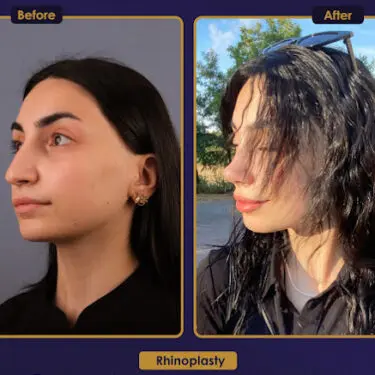 Rhinoplastik