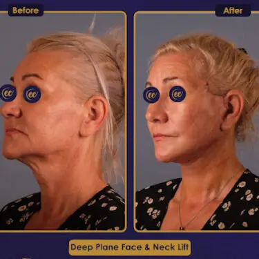 Facelift