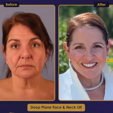 Facelift