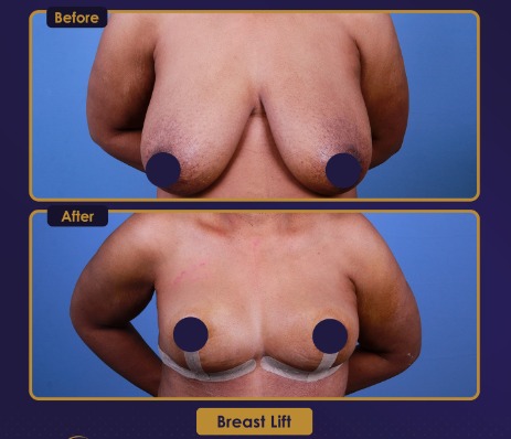 Elevación de mamas