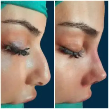Rhinoplastik