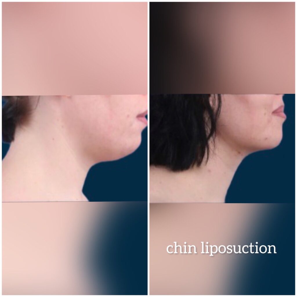 Chin Liposuction