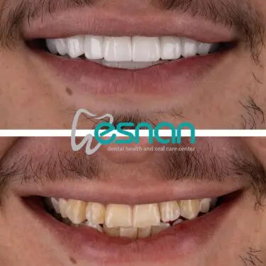 Aesthetic dentistry in Turkey