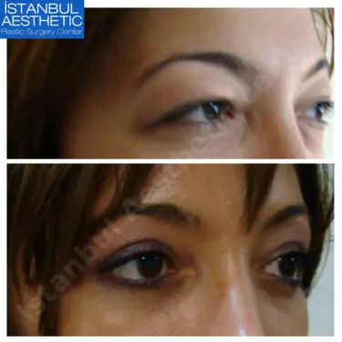 Блефаропластика