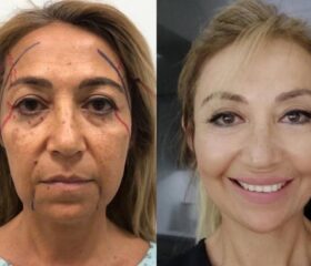 Face plastic surgery