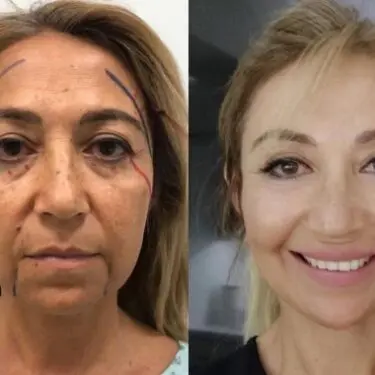 Cirugía de cara y cuello 