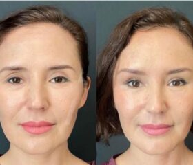 Face plastic surgery