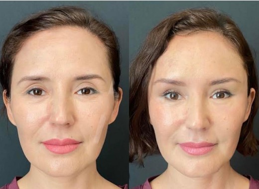 Cirugia plastica facial