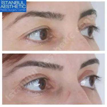 Блефаропластика