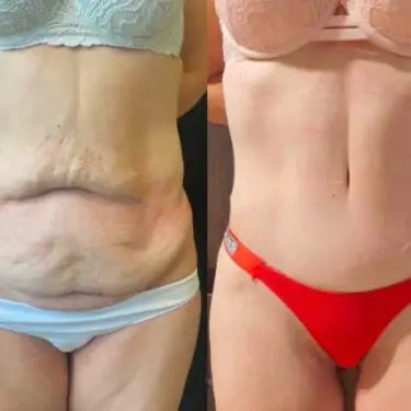 Abdominoplastia