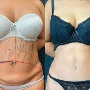 Abdominoplastia