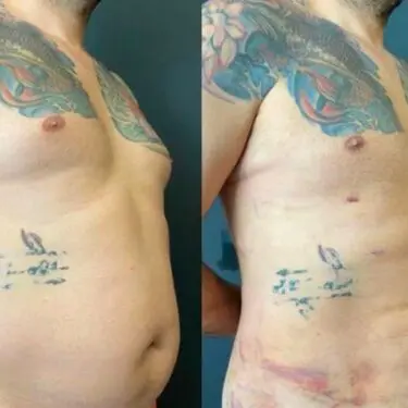 Abdominoplastia