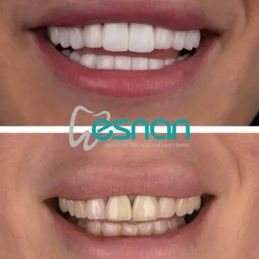 Sourire hollywoodien (facettes)