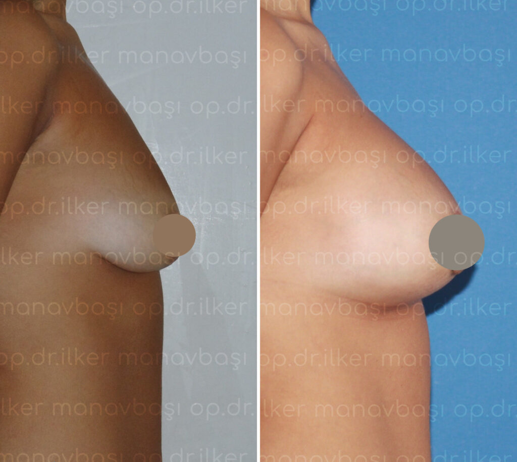 Cirugía plástica mamaria
