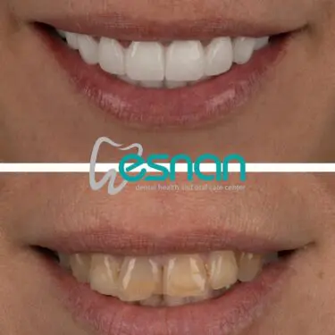 Sourire hollywoodien (facettes)