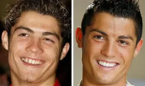 Veneers vorher und nachher