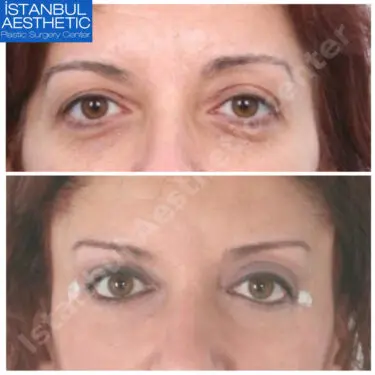 Блефаропластика