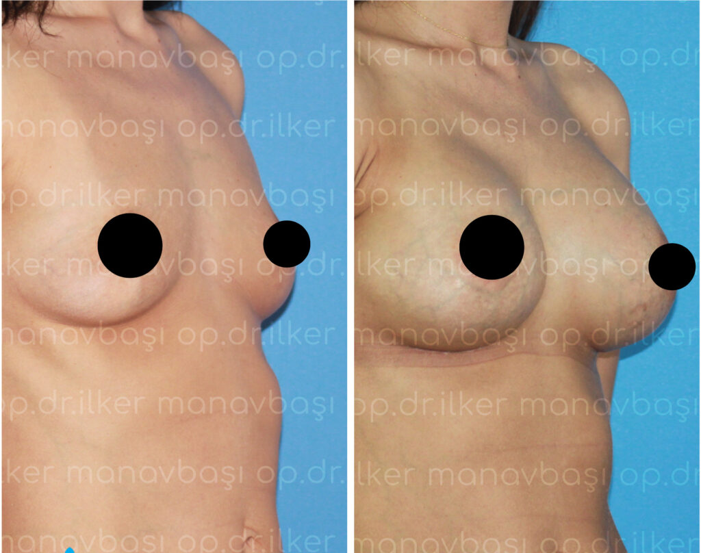Breast plastic surgery