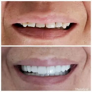Hollywood-Lächeln (Veneers)