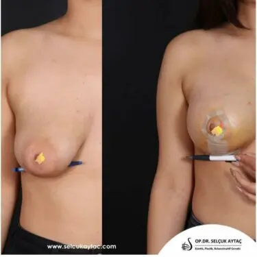 Mammoplastik