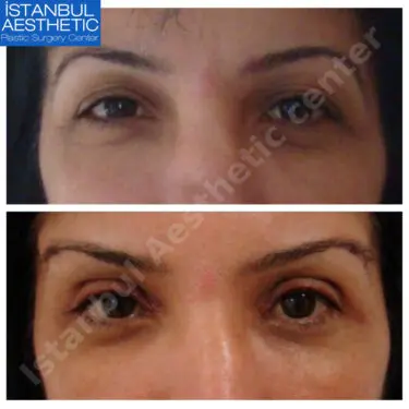 Блефаропластика