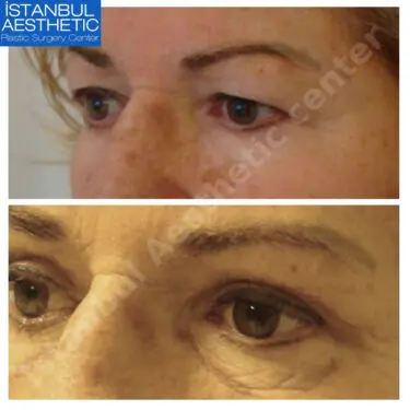 Блефаропластика