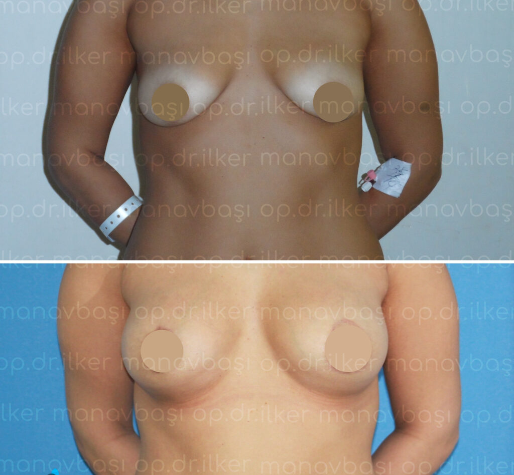 Cirugía plástica mamaria