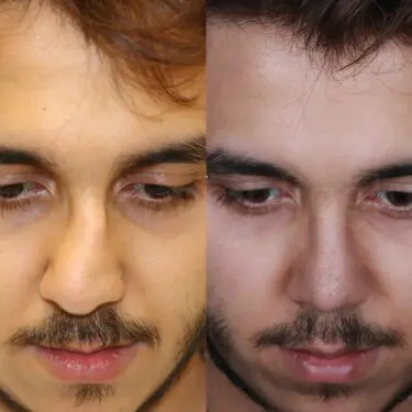 Rhinoplastik