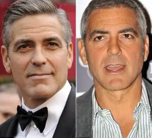 блефаропластика у мужчин